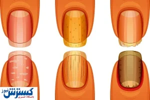 تشخیص سرطان ریه از روی ناخن ممکن شد