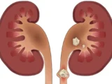 سنگ کلیه چه علائمی دارد؟