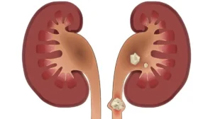 سنگ کلیه چه علائمی دارد؟